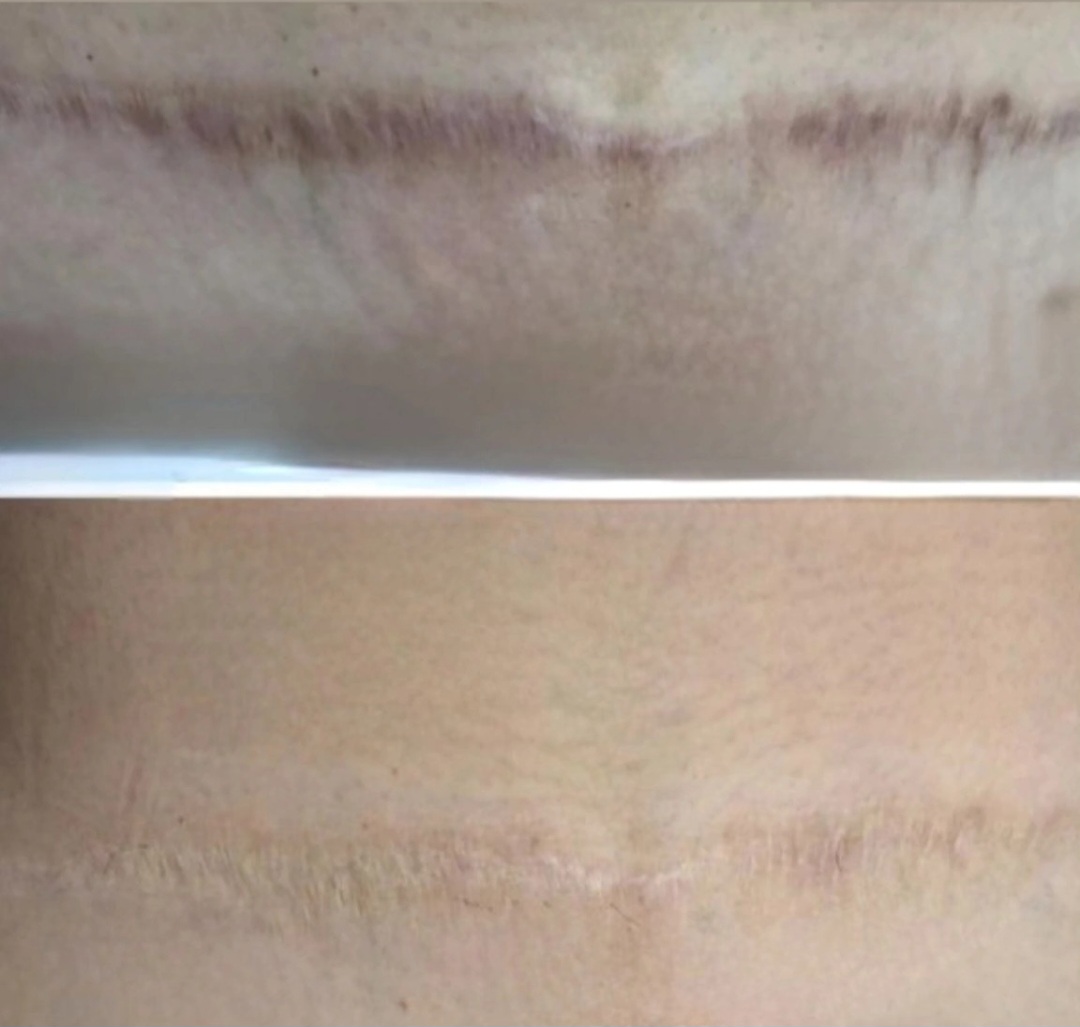 Medical tattoo result 4