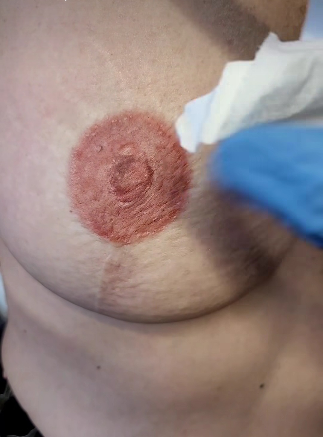 Medical tattoo result 11