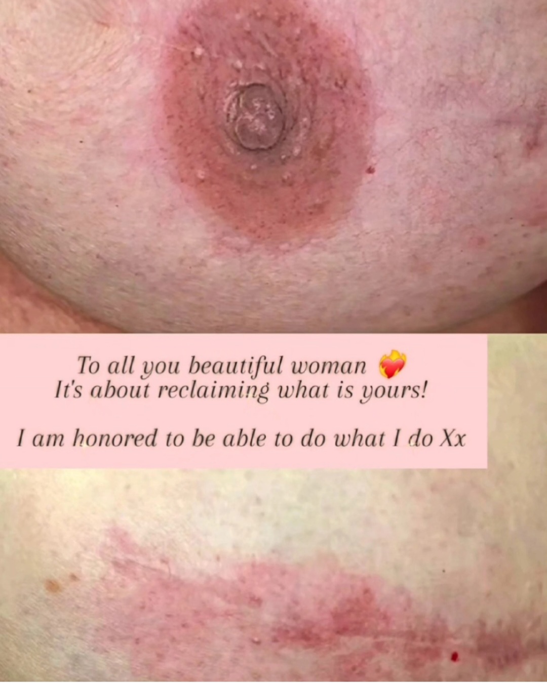 Medical tattoo result 2